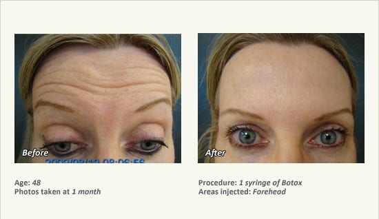 BOTOX® Cosmetic & Dysport® Treatment in Plano & Dallas - Patient 43