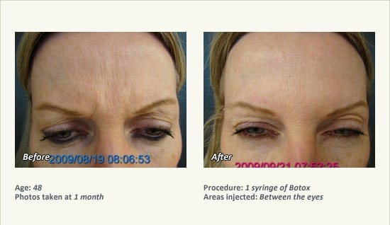 BOTOX® Cosmetic & Dysport® Treatment in Plano & Dallas - Patient 44