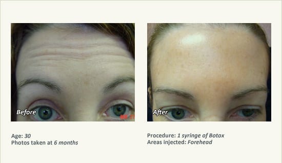 BOTOX® Cosmetic & Dysport® Treatment in Plano & Dallas - Patient 45