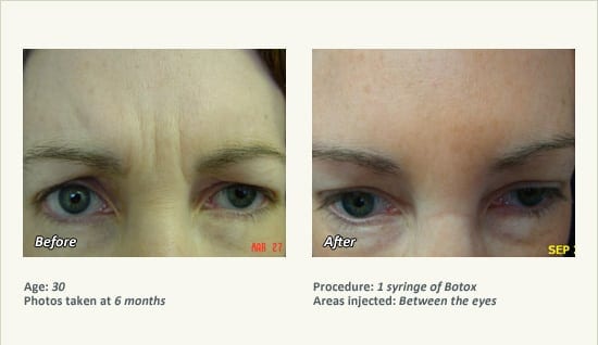 BOTOX® Cosmetic & Dysport® Treatment in Plano & Dallas - Patient 46