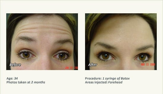BOTOX® Cosmetic & Dysport® Treatment in Plano & Dallas - Patient 47