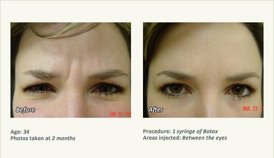 BOTOX® Cosmetic & Dysport® Treatment in Plano & Dallas - Patient 48