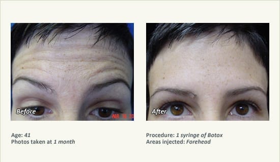 BOTOX® Cosmetic & Dysport® Treatment in Plano & Dallas - Patient 49