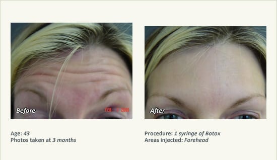 BOTOX® Cosmetic & Dysport® Treatment in Plano & Dallas - Patient 51
