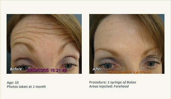 BOTOX® Cosmetic & Dysport® Treatment in Plano & Dallas - Patient 53
