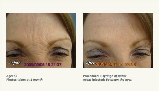 BOTOX® Cosmetic & Dysport® Treatment in Plano & Dallas - Patient 54