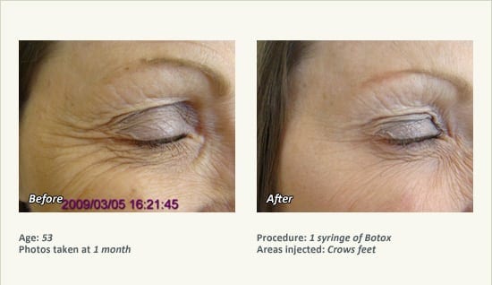 BOTOX® Cosmetic & Dysport® Treatment in Plano & Dallas - Patient 55
