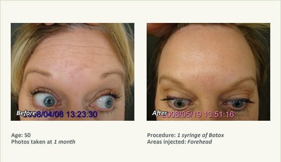 BOTOX® Cosmetic & Dysport® Treatment in Plano & Dallas - Patient 56