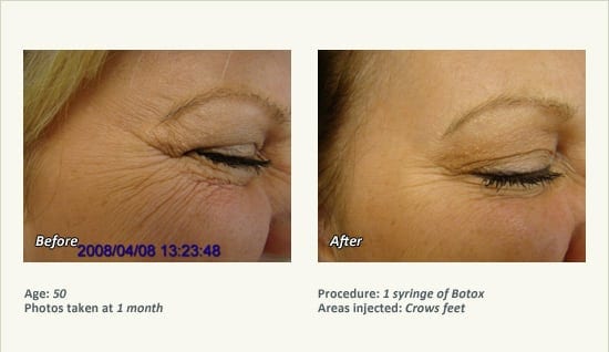 BOTOX® Cosmetic & Dysport® Treatment in Plano & Dallas - Patient 57