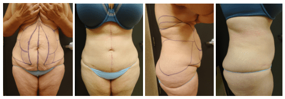 Before & After Liposuction | Ronald M. Friedman, M.D."