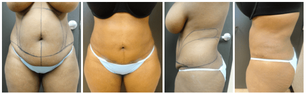 Before & After Liposuction | Ronald M. Friedman, M.D."