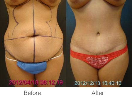 Before & After Liposuction | Ronald M. Friedman, M.D."