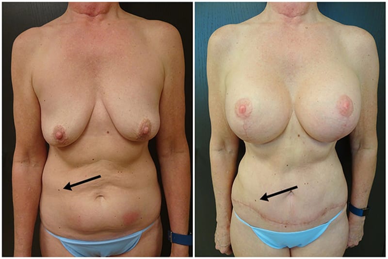 Tummy Tuck patient results