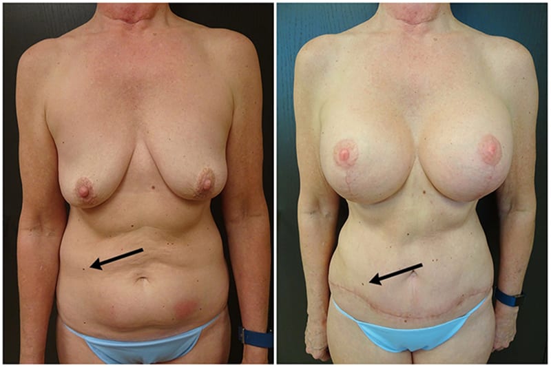 Full Tummy Tuck Results