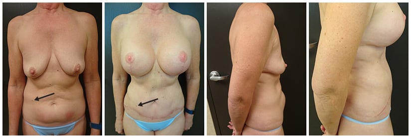 Tummy Tuck Results