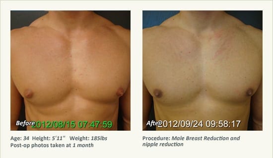 Male Breast Reduction Surgery in Plano, TX - Patient 21