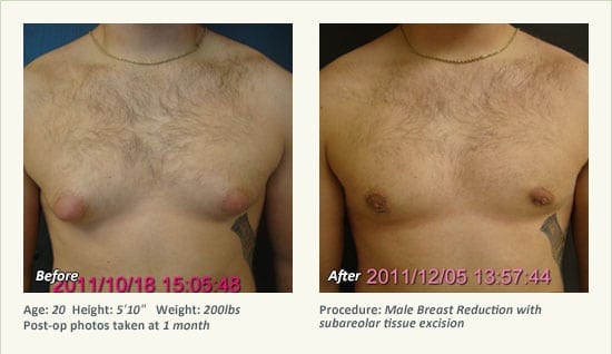 Male Breast Reduction Surgery in Plano, TX - Patient 23