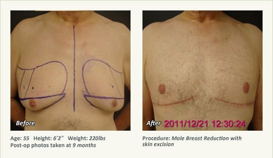 Male Breast Reduction Surgery in Plano, TX - Patient 25