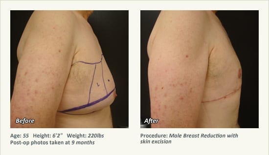 Male Breast Reduction Surgery in Plano, TX - Patient 26