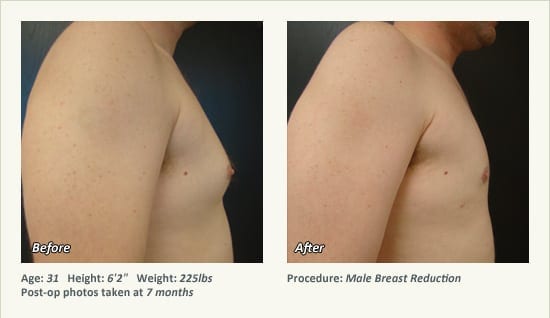 Male Breast Reduction Surgery in Plano, TX - Patient 41