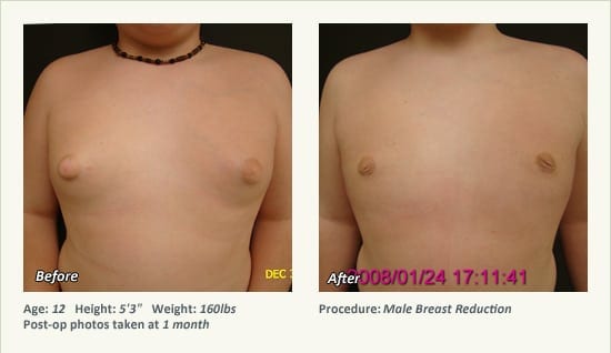 Male Breast Reduction Surgery in Plano, TX - Patient 27