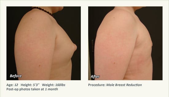 Male Breast Reduction Surgery in Plano, TX - Patient 28