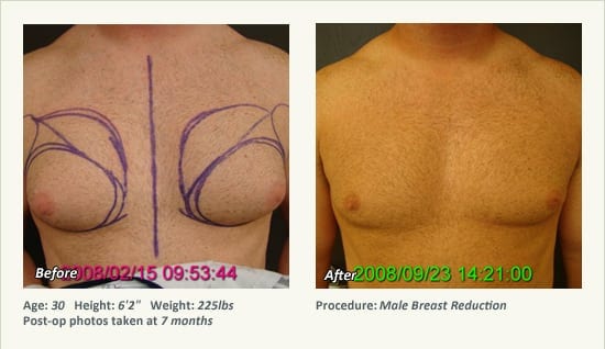Male Breast Reduction Surgery in Plano, TX - Patient 29