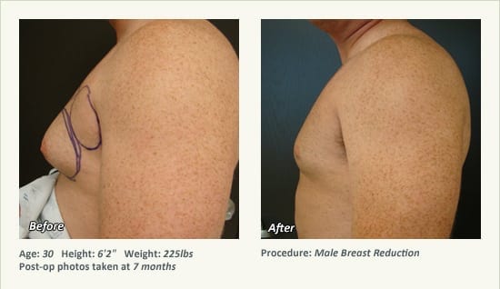 Male Breast Reduction Surgery in Plano, TX - Patient 30