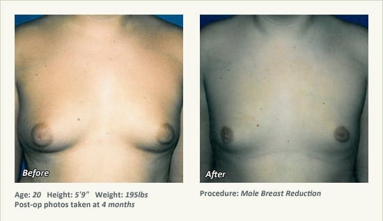 Male Breast Reduction Surgery in Plano, TX - Patient 31