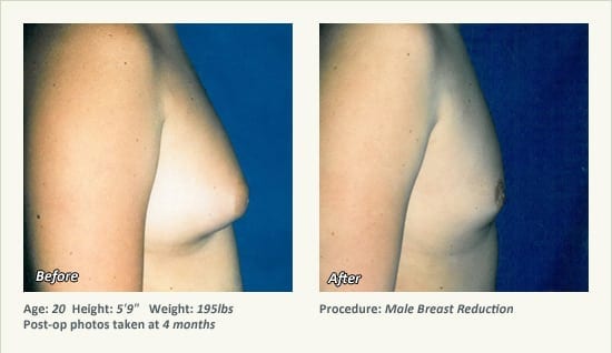 Male Breast Reduction Surgery in Plano, TX - Patient 32