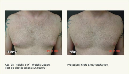 Male Breast Reduction Surgery in Plano, TX - Patient 33