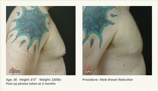 Male Breast Reduction Surgery in Plano, TX - Patient 34