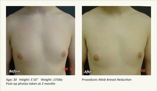 Male Breast Reduction Surgery in Plano, TX - Patient 35