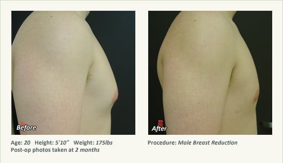 Male Breast Reduction Surgery in Plano, TX - Patient 36