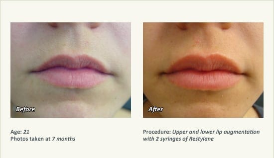 Lip Augmentation in Plano, TX - Patient 5