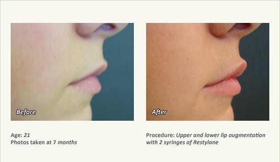 Lip Augmentation in Plano, TX - Patient 6