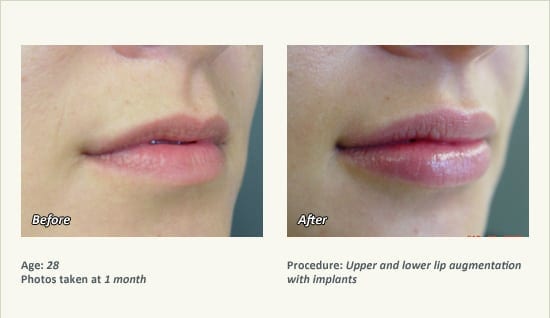 Lip Augmentation in Plano, TX - Patient 8