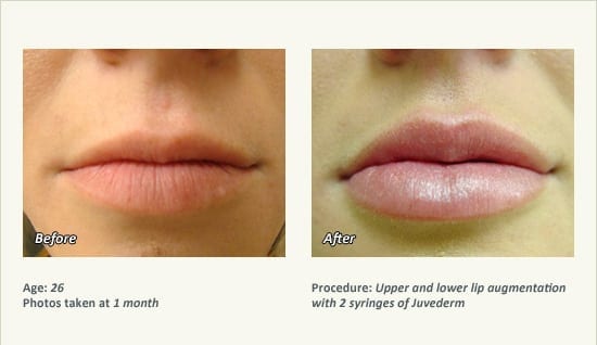 Lip Augmentation in Plano, TX - Patient 1