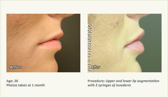 Lip Augmentation in Plano, TX - Patient 2