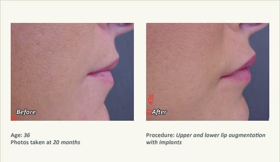Lip Augmentation in Plano, TX - Patient 10