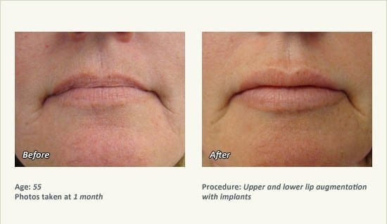 Lip Augmentation in Plano, TX - Patient 11