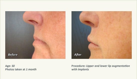 Lip Augmentation in Plano, TX - Patient 12