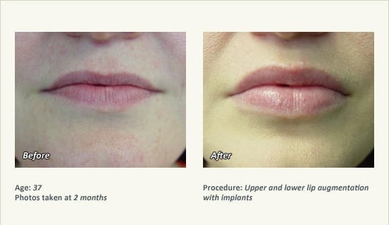 Lip Augmentation in Plano, TX - Patient 13