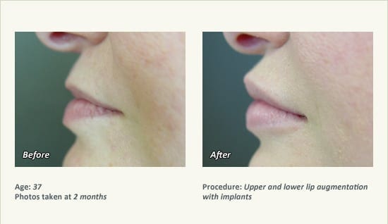 Lip Augmentation in Plano, TX - Patient 14