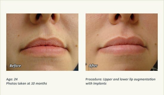 Lip Augmentation in Plano, TX - Patient 15