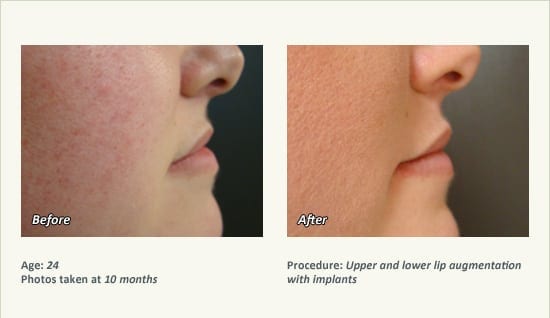 Lip Augmentation in Plano, TX - Patient 16