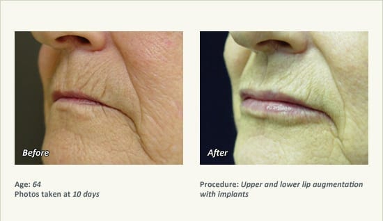 Lip Augmentation in Plano, TX - Patient 18