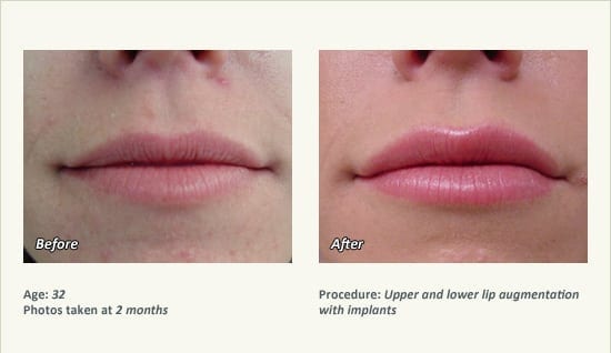 Lip Augmentation in Plano, TX - Patient 19