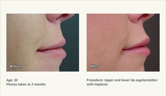 Lip Augmentation in Plano, TX - Patient 20