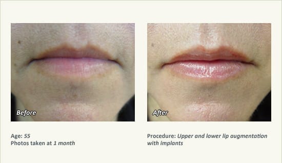 Lip Augmentation in Plano, TX - Patient 21